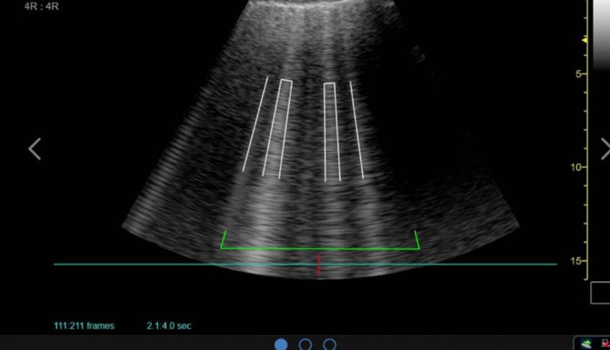 AI-Enhanced Point of Care Ultrasound (POCUS) Is Helping On The Front Line Against COVID-19
