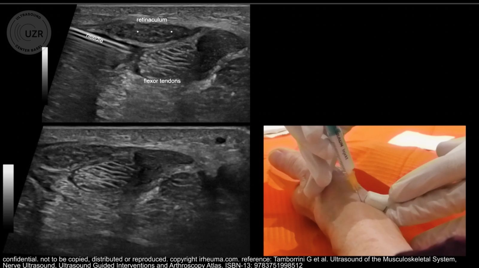 The use of ultrasound to assess carpal tunnel syndrome.