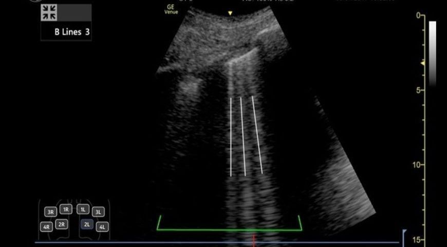 Lung Ultrasound Point of Care and AI Technology