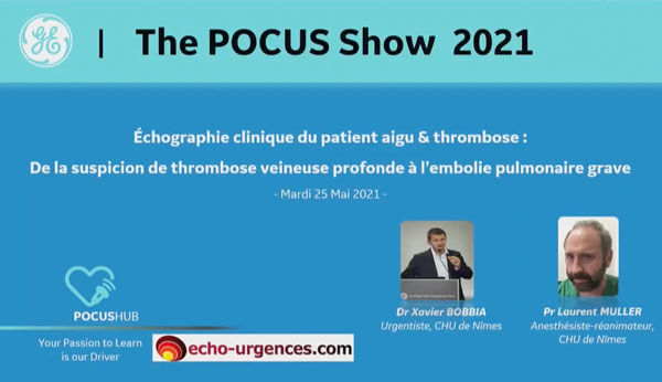 Echographie clinique du patient aigu & thrombose :  De la suspicion de thrombose veineuse prodonde à l'embolie pulmonaire grave