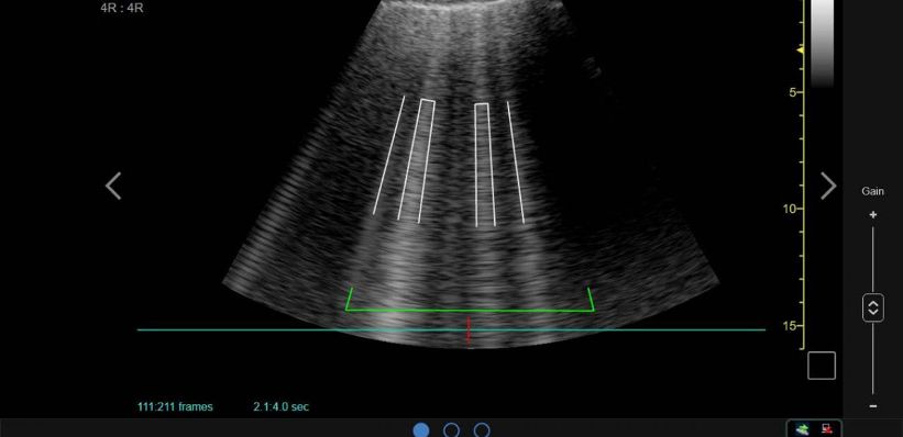 AI-Enhanced Point of Care Ultrasound (POCUS) Is Helping On The Front Line Against COVID-19