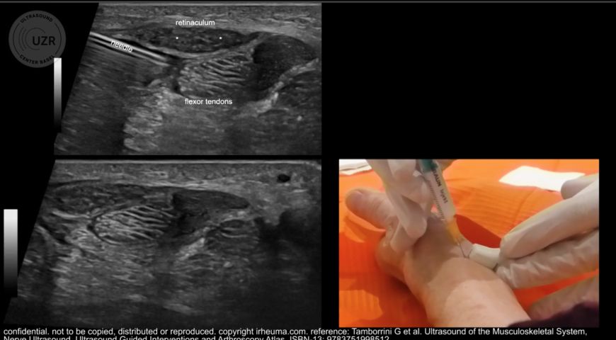 The use of ultrasound to assess carpal tunnel syndrome.