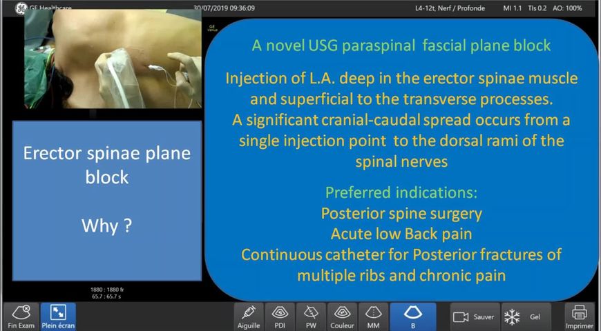 Learn why and how to perform the thoracic erector spinae plane block