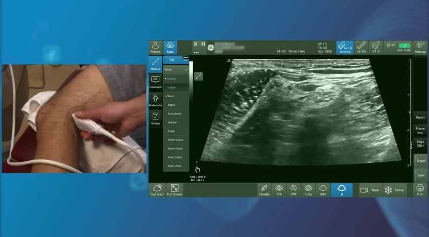 Popliteal Sciatic Nerve Block with Dr Amit Pawa