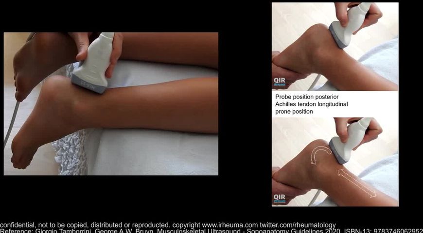 Ultrasound of the Achilles tendon