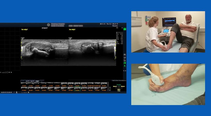 How to Assess Gout through Ultrasound