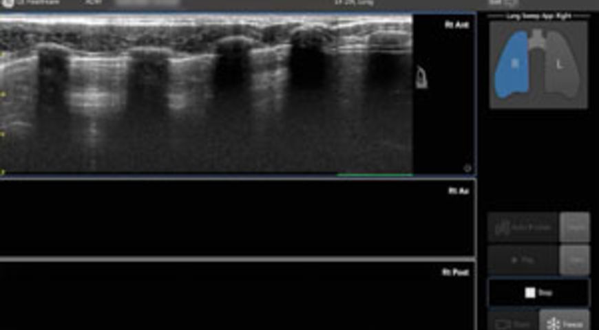 How to use the new Lung Tool (Lung Sweep)
